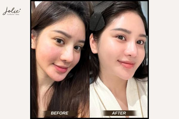 GET THAT COVETED GLOW WITH MESO GLOWING SKIN INJECTIONS